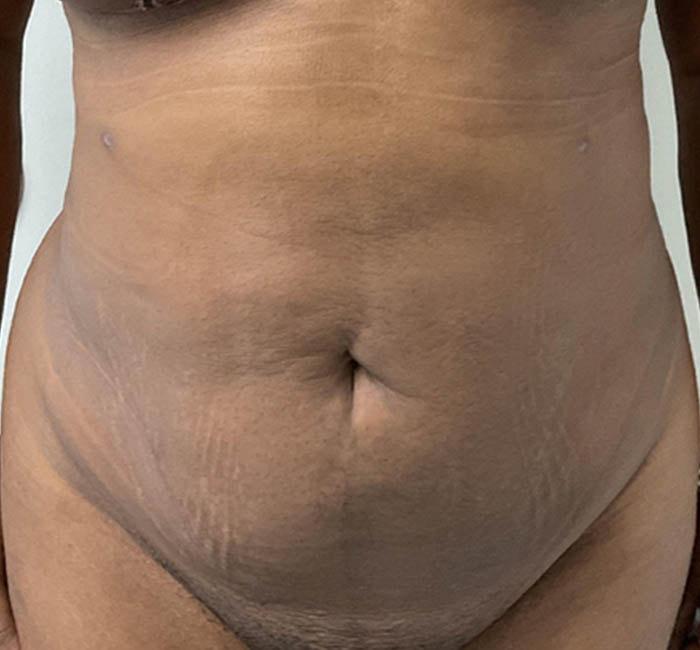 New You Plastic Surgery tummy tuck after — Roslyn, NY