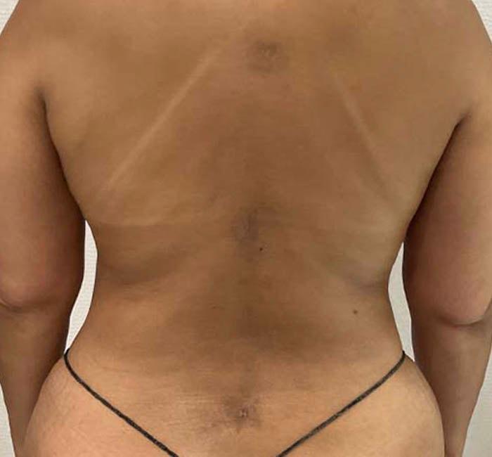 New You Plastic Surgery liposuction after — Roslyn, NY