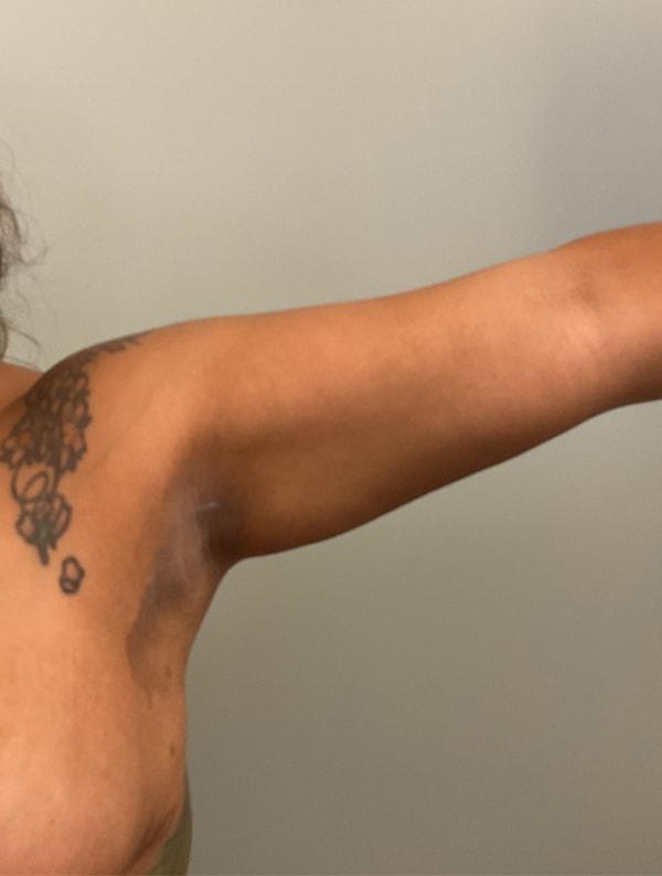 New You Plastic Surgery liposuction after — Roslyn, NY