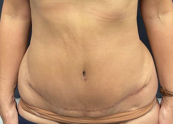 New You Plastic Surgery tummy tuck after — Roslyn, NY