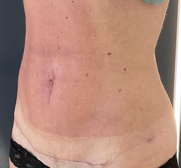 New You Plastic Surgery tummy tuck after — Roslyn, NY