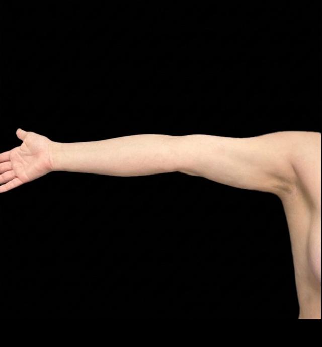Liposuction after at Panache Plastic Surgery in Newport Beach, CA
