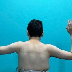 Arm Lift after at Panache Plastic Surgery in Newport Beach, CA