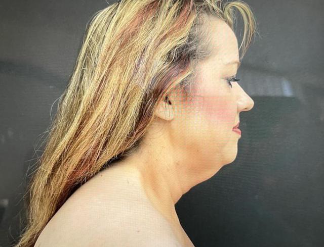 Neck Lift before at Panache Plastic Surgery in Newport Beach, CA