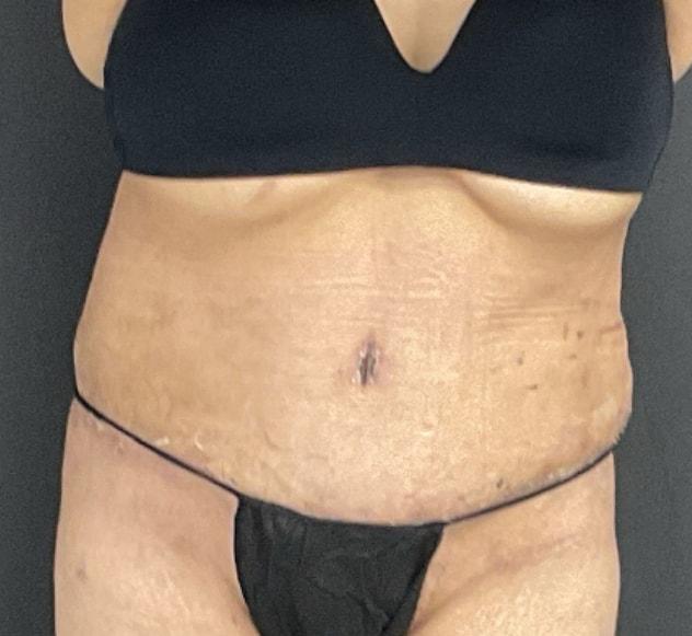 Panache Plastic Surgery tummy tuck after — Newport Beach, CA