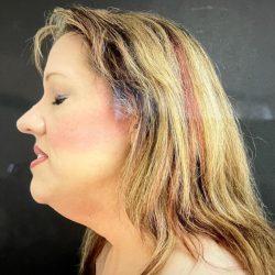 Liposuction before at Panache Plastic Surgery in Newport Beach, CA