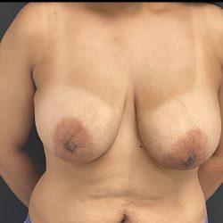 Breast Reduction before at Panache Plastic Surgery in Newport Beach, CA