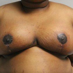 Breast Reduction after at Panache Plastic Surgery in Newport Beach, CA