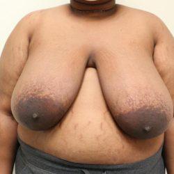 Breast Reduction before at Panache Plastic Surgery in Newport Beach, CA