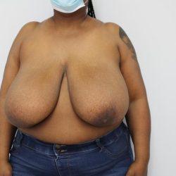 Breast Reduction before at Panache Plastic Surgery in Newport Beach, CA