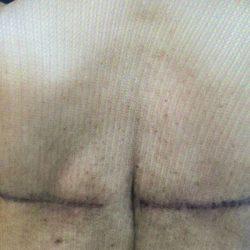 Gynecomastia Surgery after at Panache Plastic Surgery in Newport Beach, CA