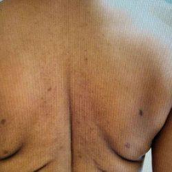 Gynecomastia Surgery before at Panache Plastic Surgery in Newport Beach, CA