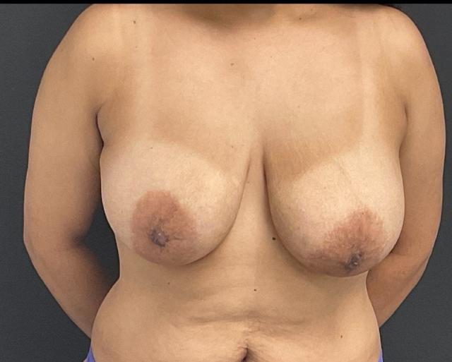 Breast Lift before at Panache Plastic Surgery in Newport Beach, CA