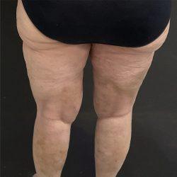 Liposuction after at Panache Plastic Surgery in Newport Beach, CA