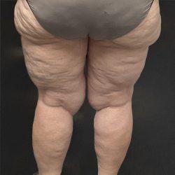Liposuction before at Panache Plastic Surgery in Newport Beach, CA