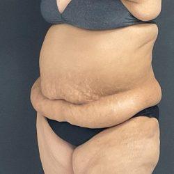 Tummy Tuck before at Panache Plastic Surgery in Newport Beach, CA