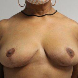 Breast Reduction after at Panache Plastic Surgery in Newport Beach, CA