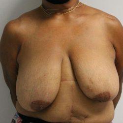 Breast Reduction before at Panache Plastic Surgery in Newport Beach, CA