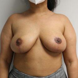 Breast Reduction after at Panache Plastic Surgery in Newport Beach, CA