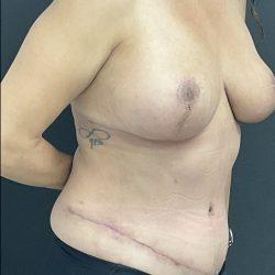Mommy Makeover after at Panache Plastic Surgery in Newport Beach, CA