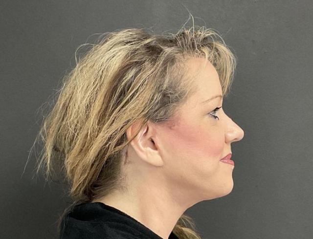 Neck Lift after at Panache Plastic Surgery in Newport Beach, CA
