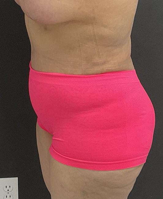Panache Plastic Surgery tummy tuck after — Newport Beach, CA