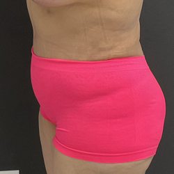 Tummy Tuck after at Panache Plastic Surgery in Newport Beach, CA