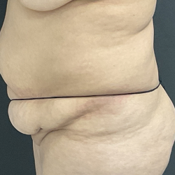 Tummy Tuck before at Panache Plastic Surgery in Newport Beach, CA