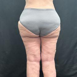 Liposuction after at Panache Plastic Surgery in Newport Beach, CA