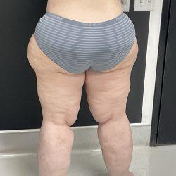 Liposuction before at Panache Plastic Surgery in Newport Beach, CA