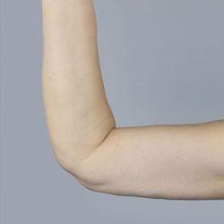 Arm Lift after at Panache Plastic Surgery in Newport Beach, CA