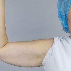 Arm Lift before at Panache Plastic Surgery in Newport Beach, CA
