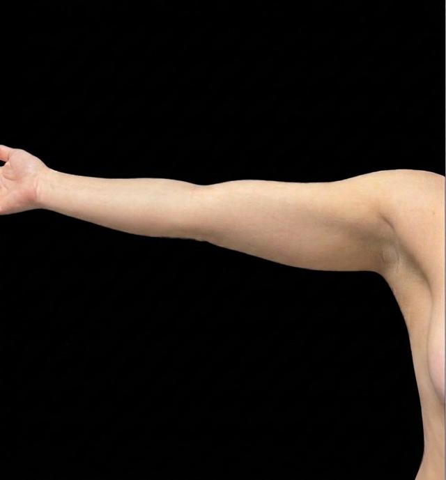 Liposuction before at Panache Plastic Surgery in Newport Beach, CA