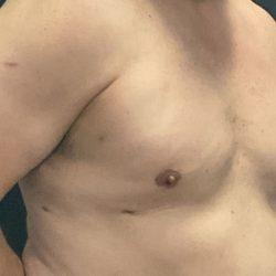 Gynecomastia Surgery after at Panache Plastic Surgery in Newport Beach, CA