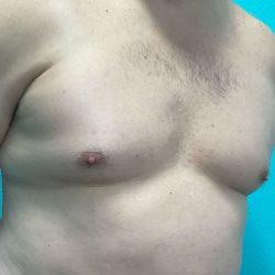 Gynecomastia Surgery before at Panache Plastic Surgery in Newport Beach, CA