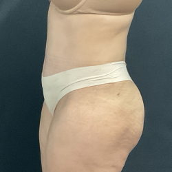 Panache Plastic Surgery tummy tuck after — Newport Beach, CA
