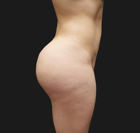 Liquid BBL after at Aristocrat Plastic Surgery in Scarsdale, NY
