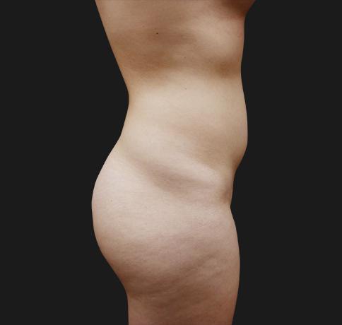 Liquid BBL before at Aristocrat Plastic Surgery in Scarsdale, NY