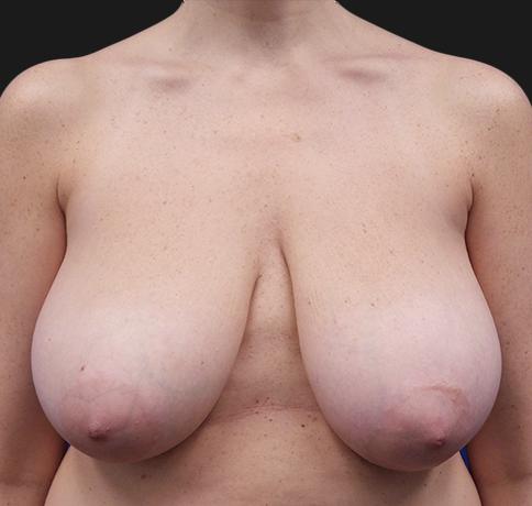 Breast Reduction before at Aristocrat Plastic Surgery in Scarsdale, NY