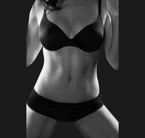 Tummy Tuck after at Aristocrat Plastic Surgery in Scarsdale, NY
