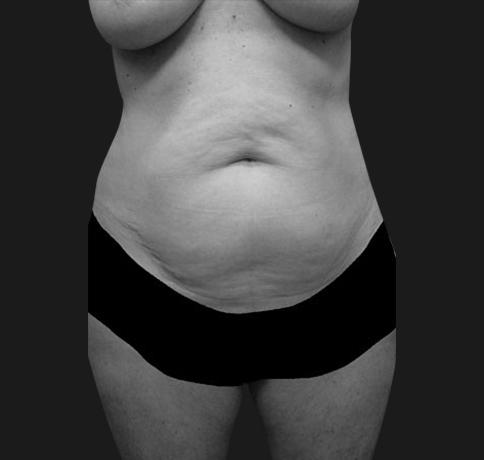 Tummy Tuck before at Aristocrat Plastic Surgery in Scarsdale, NY
