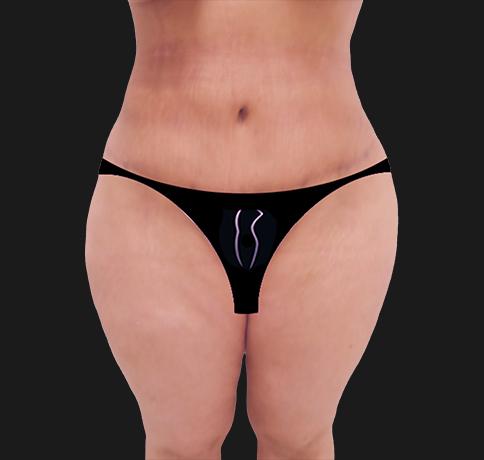 Liposuction after at Aristocrat Plastic Surgery in Scarsdale, NY