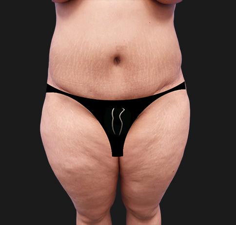 Liposuction before at Aristocrat Plastic Surgery in Scarsdale, NY