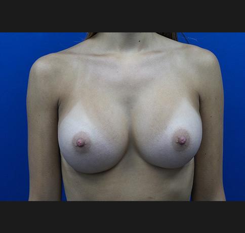 Aristocrat Plastic Surgery breast augmentation after — Scarsdale, NY