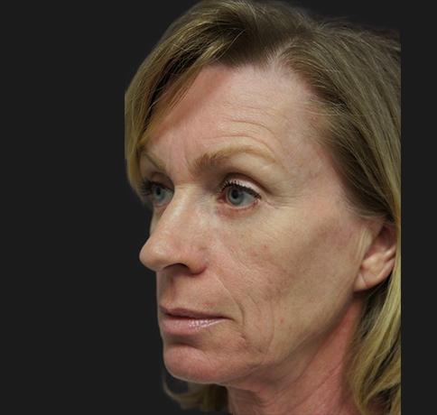 Aristocrat Plastic Surgery blepharoplasty after — Scarsdale, NY