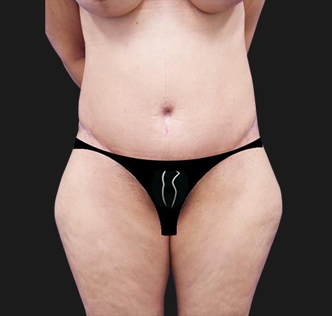 Tummy Tuck after at Aristocrat Plastic Surgery in Scarsdale, NY