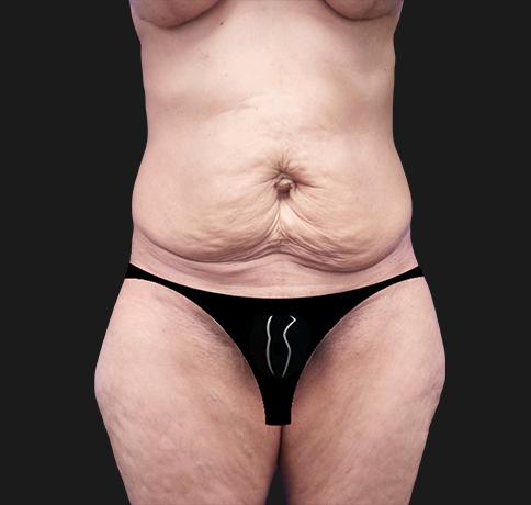 Tummy Tuck before at Aristocrat Plastic Surgery in Scarsdale, NY