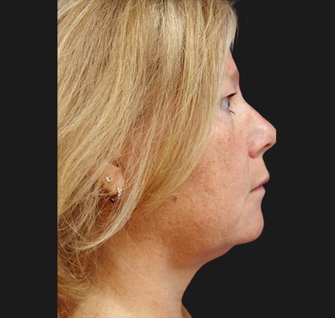 Neck Lift after at Aristocrat Plastic Surgery in Scarsdale, NY