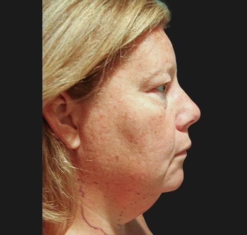 Neck Lift before at Aristocrat Plastic Surgery in Scarsdale, NY