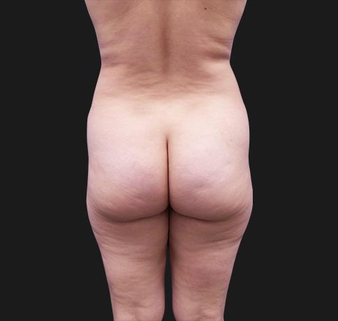 Liquid BBL before at Aristocrat Plastic Surgery in Scarsdale, NY